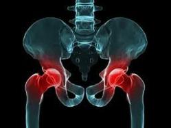Wright Profemur Hip Replacement Adverse events